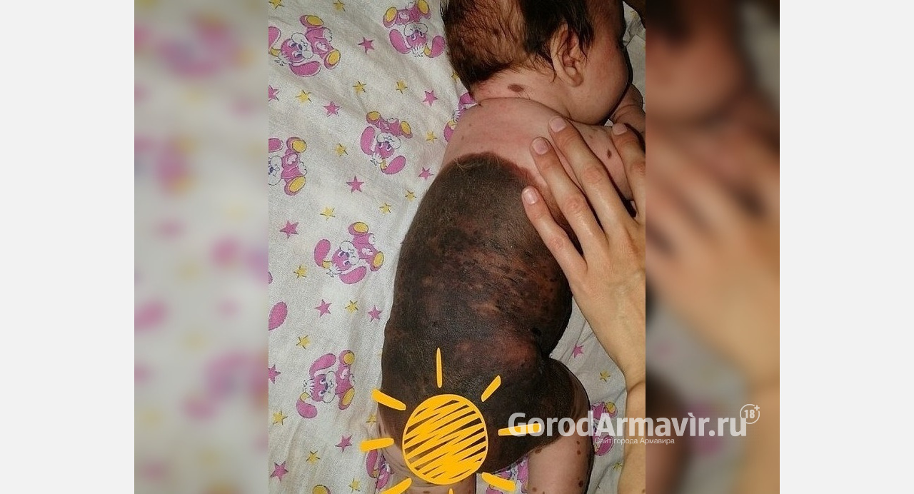 Кубанские врачи осмотрят девочку с огромным родимым пятном на теле 